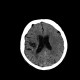 Stroke, cerebral ischemia, insula, caudate: CT - Computed tomography
